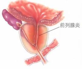 尿道口尿滴白——前列腺疾病的征兆!