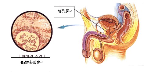 治疗男性前列腺炎的费用要多少