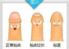 怎样才能判断男子包皮过长？