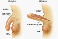 什么是阳痿？严重么？