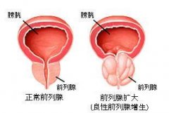 确诊前列腺增生前需要做哪些检查
