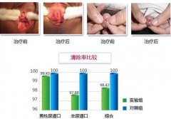 针对性治疗尿道炎，一步到位