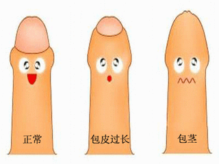 包茎该如何检查？