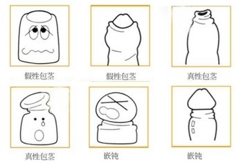 包茎有哪些危害？
