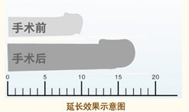 阴茎短小可以从哪些方面检查？