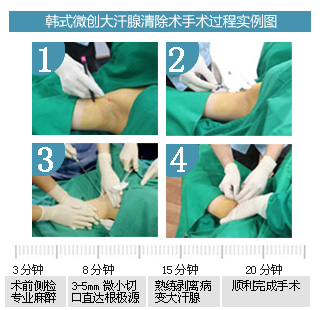 中韩专家联合为上海复发性腋臭患者成功手术.jpg