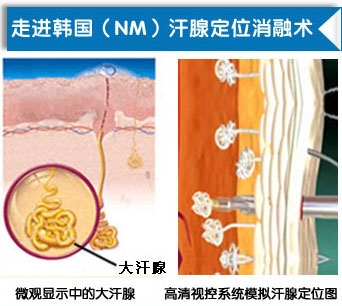 韩式微创可视大汗腺清除术