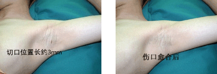 韩式微创可视大汗腺清除术前后对比.GIF